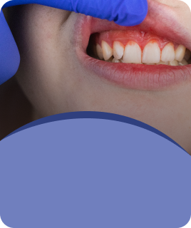 Bleeding Gums Treatment