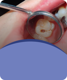 Tooth Fillings
